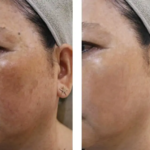 Điều trị Rối loạn Sắc tố Da (Melasma – Nám da)