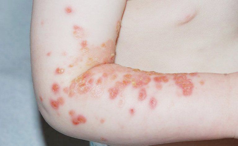 Chốc lở đóng vảy màu mật ong ở trẻ em 