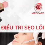 Điều trị sẹo lồi