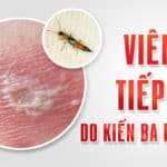 Viêm da tiếp xúc do Kiến ba khoang