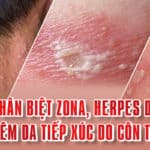 Phân biệt ZONA, Viêm da tiếp xúc do côn trùng và HERPES da