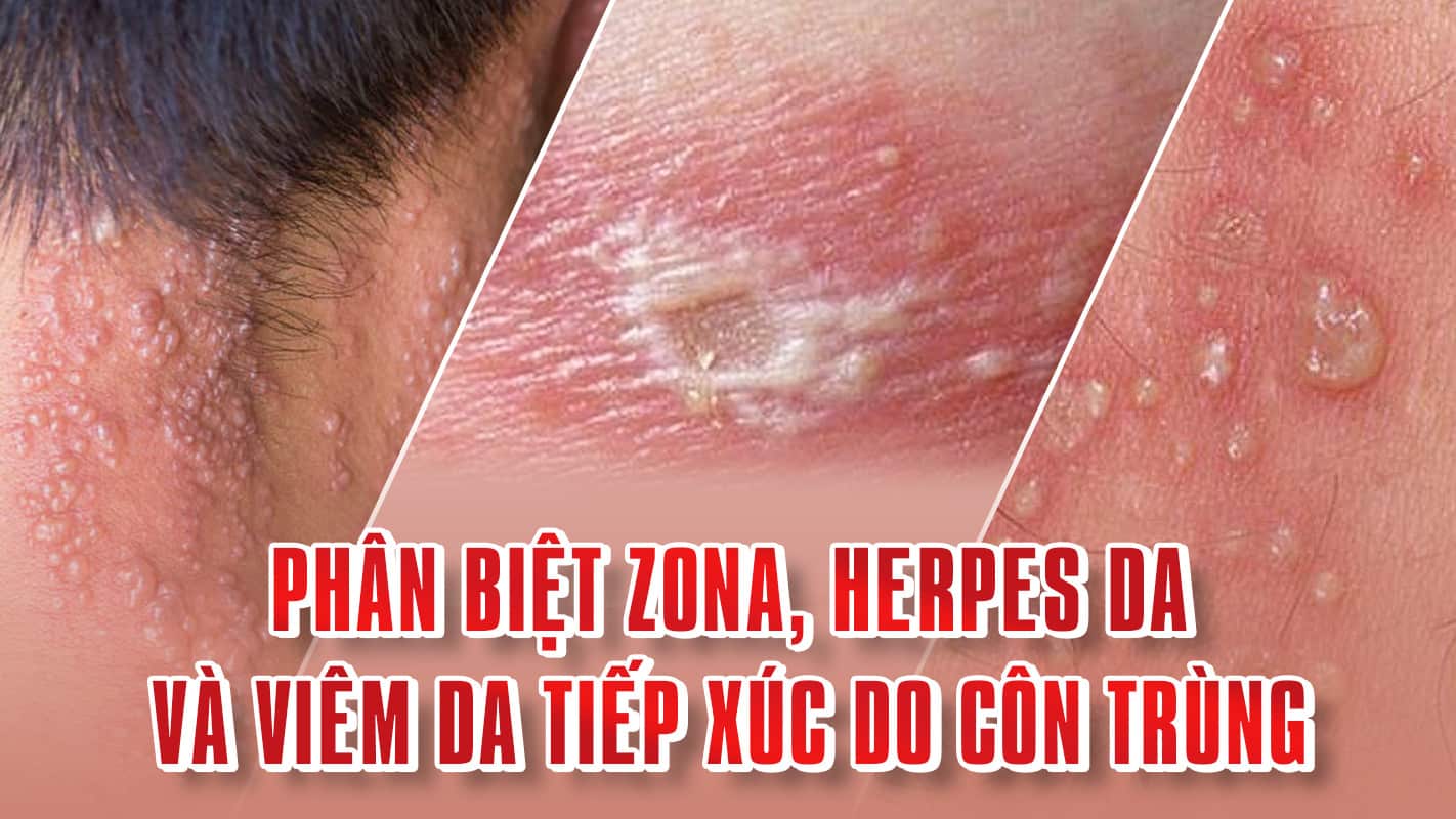 Phân biệt ZONA, Viêm da tiếp xúc do côn trùng và HERPES da