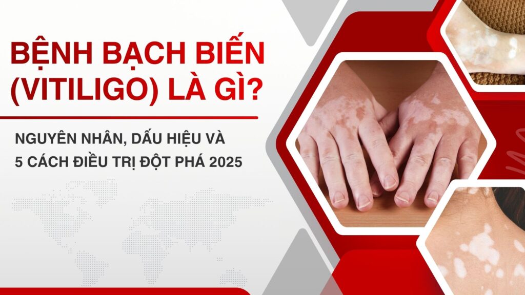 Bệnh Bạch biến (Vitiligo) là gì? Nguyên nhân, Dấu hiệu và 5 Cách điều trị đột phá 2025