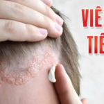 VIÊM DA TIẾT BÃ