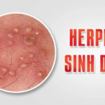 HERPES SINH DỤC