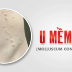 U MỀM LÂY (MOLLUSCUM CONTAGIOSUM) 