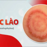 Hắc lào và những điều cần biết