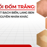 Da nổi đốm trắng: Phân biệt bạch biến, lang ben và các nguyên nhân khác