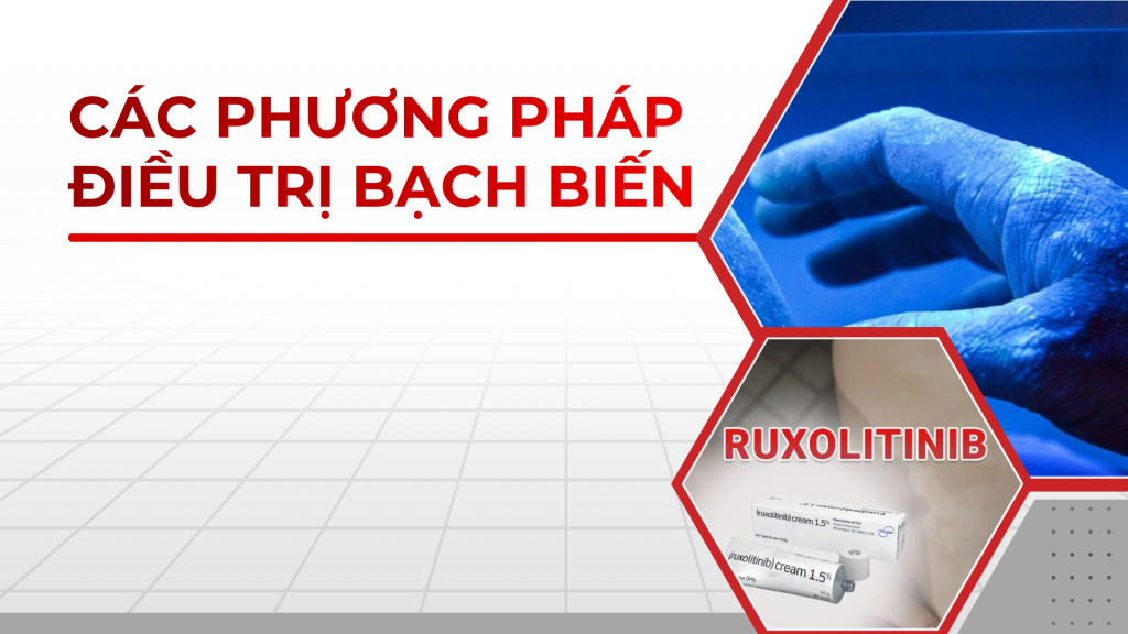 Các phương pháp điều trị bạch biến hiện nay
