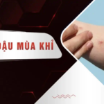 BỆNH ĐẬU MÙA KHỈ: BỆNH MỚI NHƯNG KHÔNG HỀ MỚI