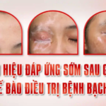 CÁC DẤU HIỆU ĐÁP ỨNG SỚM SAU GHÉP DA, CẤY TẾ BÀO ĐIỀU TRỊ BỆNH BẠCH BIẾN