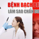 Chẩn đoán bệnh bạch biến