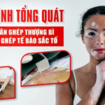 QUY TRÌNH TỔNG QUÁT BỆNH NHÂN GHÉP THƯỢNG BÌ TỰ THÂN / GHÉP TẾ BÀO SẮC TỐ