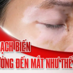 BỆNH BẠCH BIẾN ẢNH HƯỞNG ĐẾN MẮT NHƯ THẾ NÀO