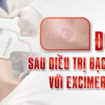 ĐỎ DA SAU ĐIỀU TRỊ BỆNH BẠCH BIẾN VỚI EXCIMER LASER