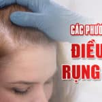 Các phương pháp điều trị rụng tóc