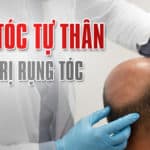 Cấy tóc tự thân điều trị rụng tóc