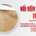 Nổi đốm trắng trên da: nguyên nhân, chẩn đoán và cách điều trị