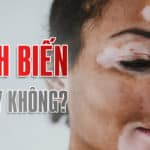 Bệnh bạch biến có lây không