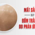 Mất sắc tố hay đốm trắng da do phản ứng viêm