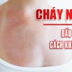 Cháy nắng: dấu hiệu và cách khắc phục