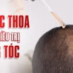 Thuốc thoa trong điều trị rụng tóc