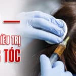 PRP trong điều trị rụng tóc