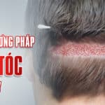 Các phương pháp cấy tóc hiện nay