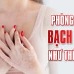 Phòng ngừa bạch biến như thế nào