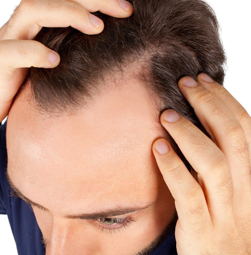 Rụng tóc nhiều ở nam giới: Dấu hiệu bệnh tật không thể chủ quan