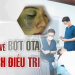 Tìm hiểu về bớt Ota và cách điều trị