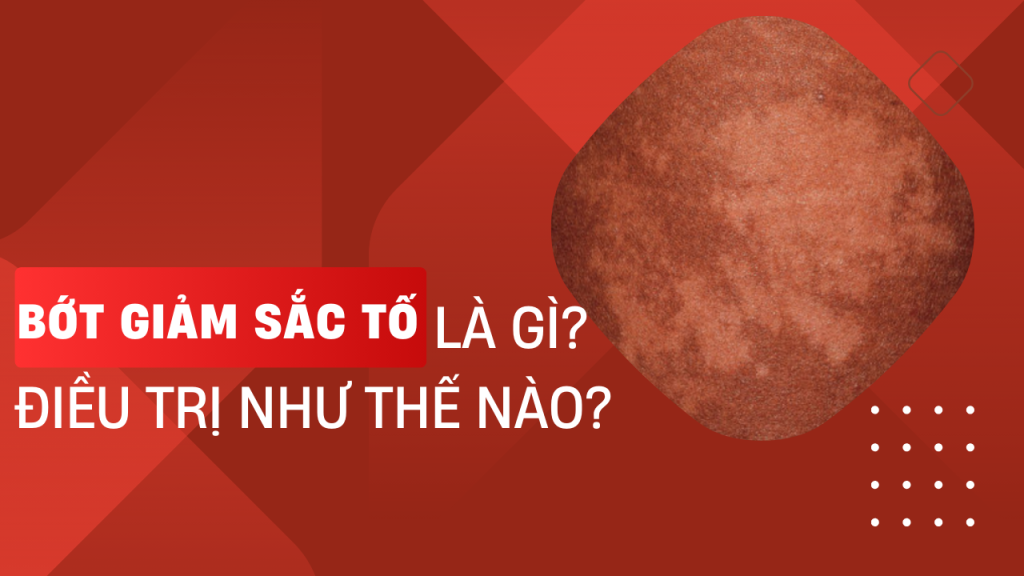 Bớt giảm sắc tố là gì và điều trị như thế nào?