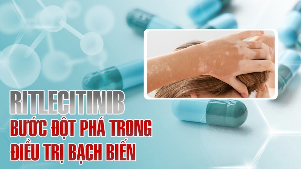 Ritlecitinib (Litfulo): Hy vọng mới cho bệnh nhân bạch biến lan rộng – Hiệu quả và Lưu ý an toàn