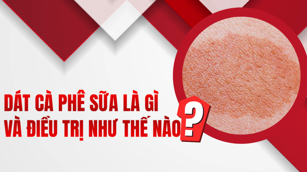 Dát cà phê sữa là gì và điều trị như thế nào