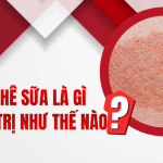 Dát cà phê sữa là gì và điều trị như thế nào