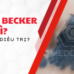 Bớt Becker là gì và điều trị như thế nào?