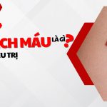 U mạch máu là gì và cách điều trị