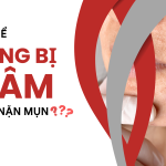 LÀM GÌ SAU KHI NẶN MỤN ĐỂ DA KHÔNG BỊ THÂM