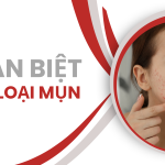 CÁC LOẠI MỤN: Phân biệt để hiểu rõ hơn