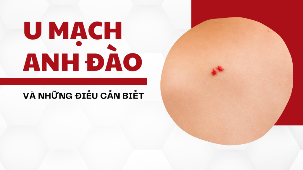 U mạch anh đào (nốt ruồi son): có nguy hiểm không, khi nào cần đi khám & cách loại bỏ an toàn (Cập nhật 08/2025)