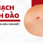 U mạch anh đào và những điều cần biết