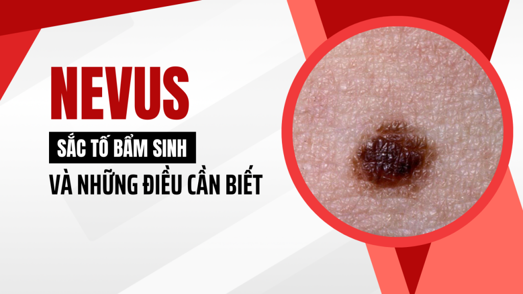 Nevus sắc tố bẩm sinh và những điều cần biết