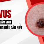 Nevus sắc tố bẩm sinh và những điều cần biết