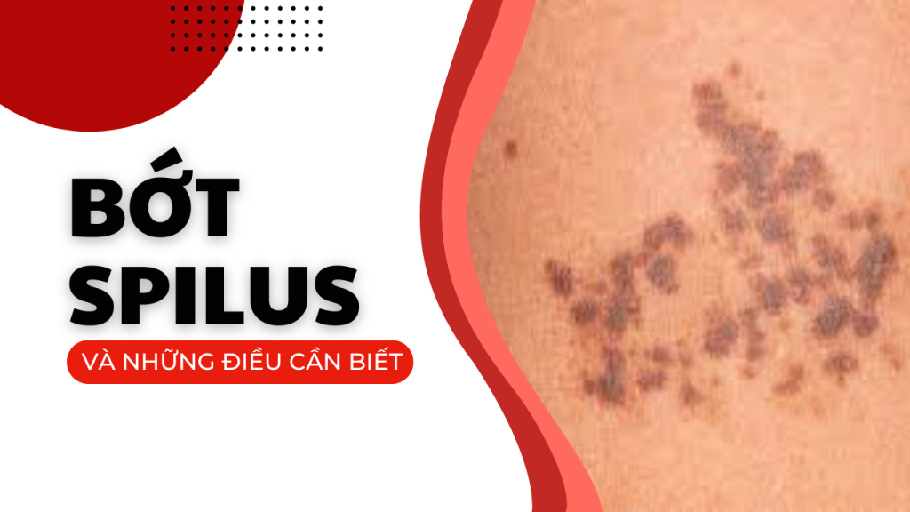 Bớt spilus và những điều cần biết