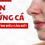 Mụn trứng cá và những điều cần biết