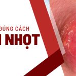 Điều trị mụn nhọt đúng cách