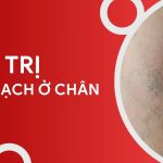 ĐIỂU TRỊ GIÃN MẠCH Ở CHÂN