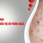 THÂM ĐỎ SAU MỤN: NGUYÊN NHÂN VÀ CÁCH ĐIỀU TRỊ