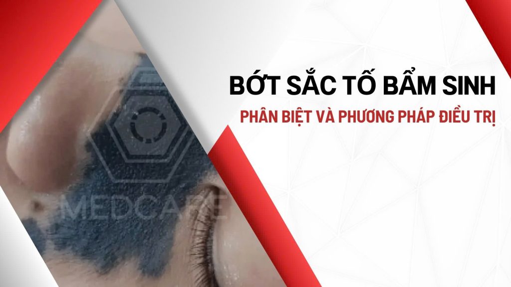 Bớt Sắc Tố Bẩm Sinh: Phân biệt và Phương Pháp Điều Trị