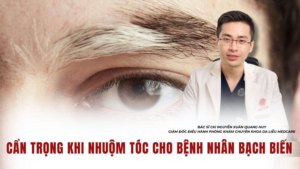 CẢNH BÁO TỪ CHUYÊN GIA: CẨN TRỌNG KHI NHUỘM TÓC CHO BỆNH NHÂN BẠCH BIẾN